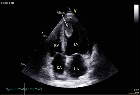 cs echo lv mass.